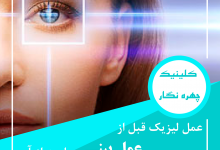 جراحی چشم لیزیک